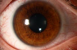 Soft Contact Lens