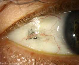 Subconjunctival foreign bodies