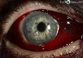 Subconjunctival hemorrhage