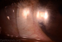 Surface Coating Loss on Scleral Lens