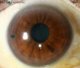 Temporal laser peripheral iridotomy