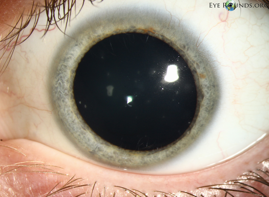 Thygeson's superficial punctate keratitis