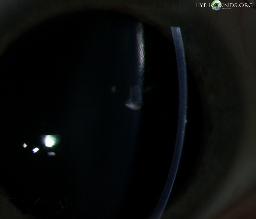 Thygeson's superficial punctate keratitis slit lamp high magnification