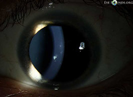 Thygeson's superficial punctate keratitis