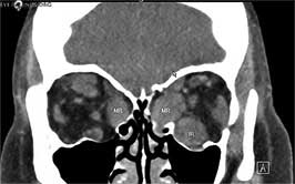Enlarged muscle bellies in thyroid eye disease