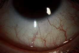 Toric Soft Contact Lens
