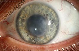 Varicella-zoster virus (VZV) disciform keratitis