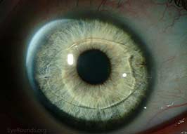 Verisyse phakic intraocular lens implant for high myopia