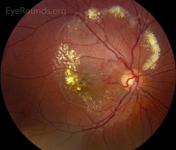 This picture is an example of a group II retinal arteriovenous malformation in which there is direct artery to vein communication without intervening capillary or arteriolar elements causing hyperdynamic flow through low resistance veins that has resulted in edema.