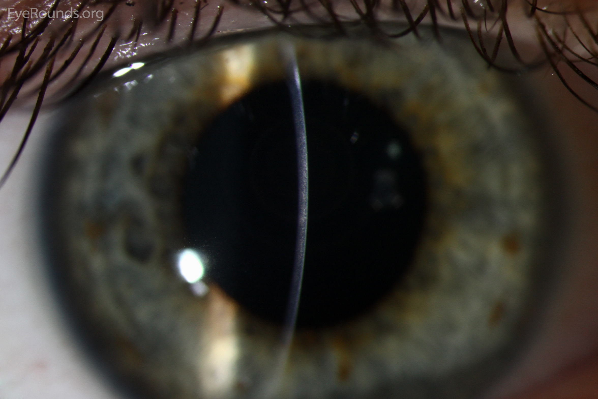 Concentric ring infiltrate in a contact lens wearer with early Acanthamoeba keratitis
