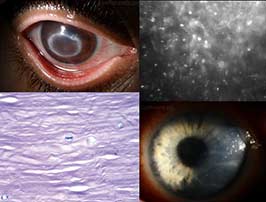 Acanthamoeba keratitis
