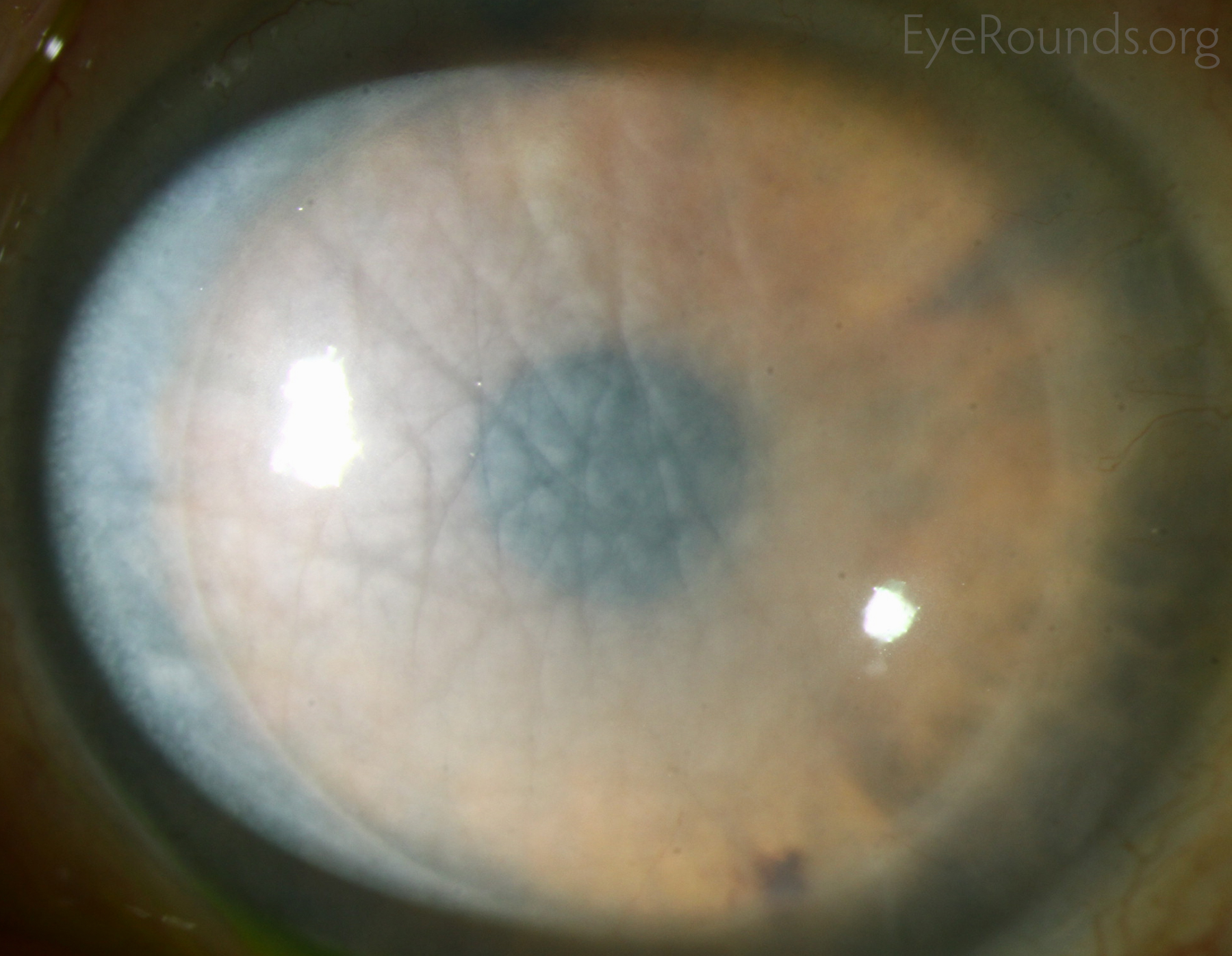 Massive corneal edema secondary to DSAEK allograft rejection.