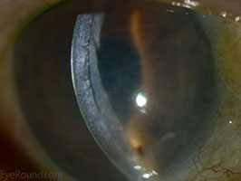 Interface fluid after DSAEK graft rejection, Acquired