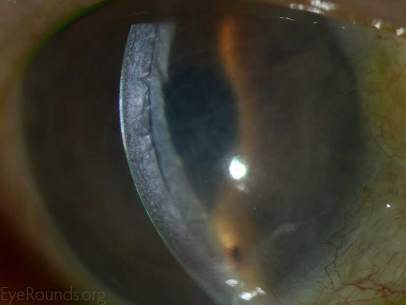 Massive corneal edema secondary to DSAEK allograft rejection. Accumulation of fluid is visible in the graft-host interface. 