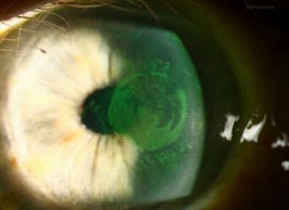 Applanation epitheliopathy