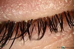 Contact dermatitis secondary to artificial eyelashes