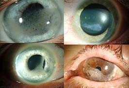 band keratopathy