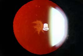 Chlorpromazine-induced cataract