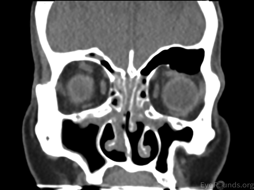 MRI head on view