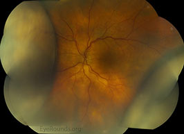 Choroidal effusion in posterior scleritis