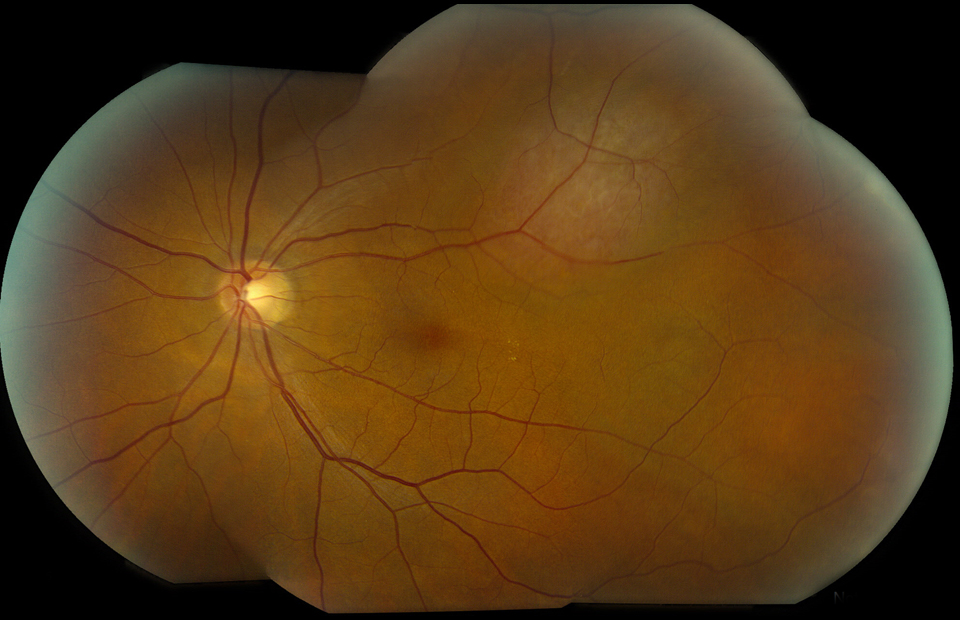 Atlas Entry Circumscribed Choroidal Hemangioma