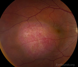 Circumscribed choroidal hemangioma