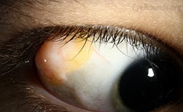 Complex choristoma of the conjunctiva