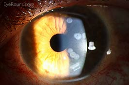 Conductive keratoplasty (CK) scars