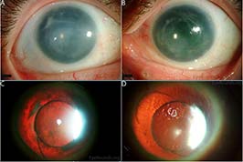 Congenital aniridia