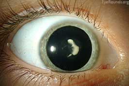 Congenital nuclear cataract