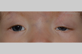 Congenital ptosis
