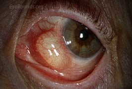 Conjunctival epithelial inclusion cyst