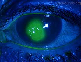 Corneal abrasion