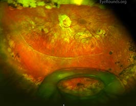 Dislocated intraocular lens implant