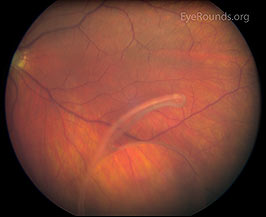 Displaced intraocular lens
