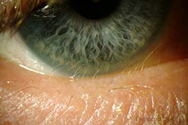 distichiasis
