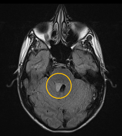MRI showing pilocytic astrocytoma