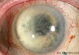 Delayed postoperative fungal endophthalmitis