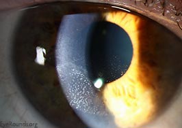 Epithelial ingrowth under LASIK flap