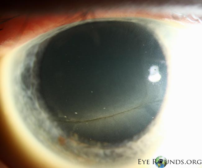 Fabry Disease, right eye