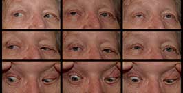 Facial Colliculus