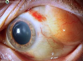Subconjunctival prolapse of orbital fat