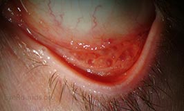 Follicular conjunctivitis