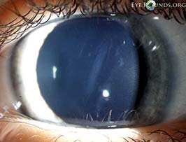 Descemet's membrane rupture secondary to forceps injury