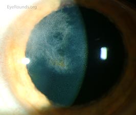 Ghost Vessels from Herpes Simplex Virus (HSV) Interstitial Keratitis
