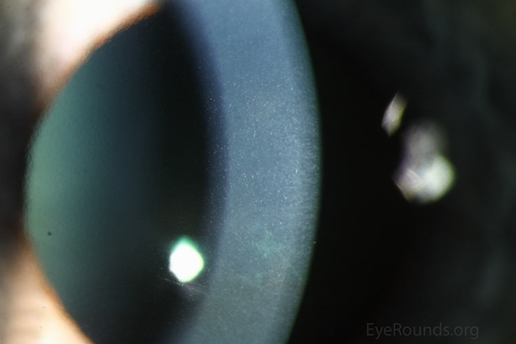excrescences of collagen produced by stressed corneal endothelial cells