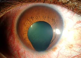 Iris coloboma