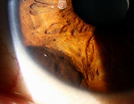 Iris melanocytoma