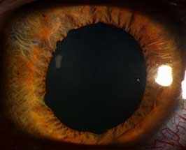 Traumatic iris sphincter tears