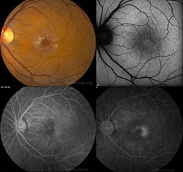 Idiopathic juxtafoveal telangiectasia type II